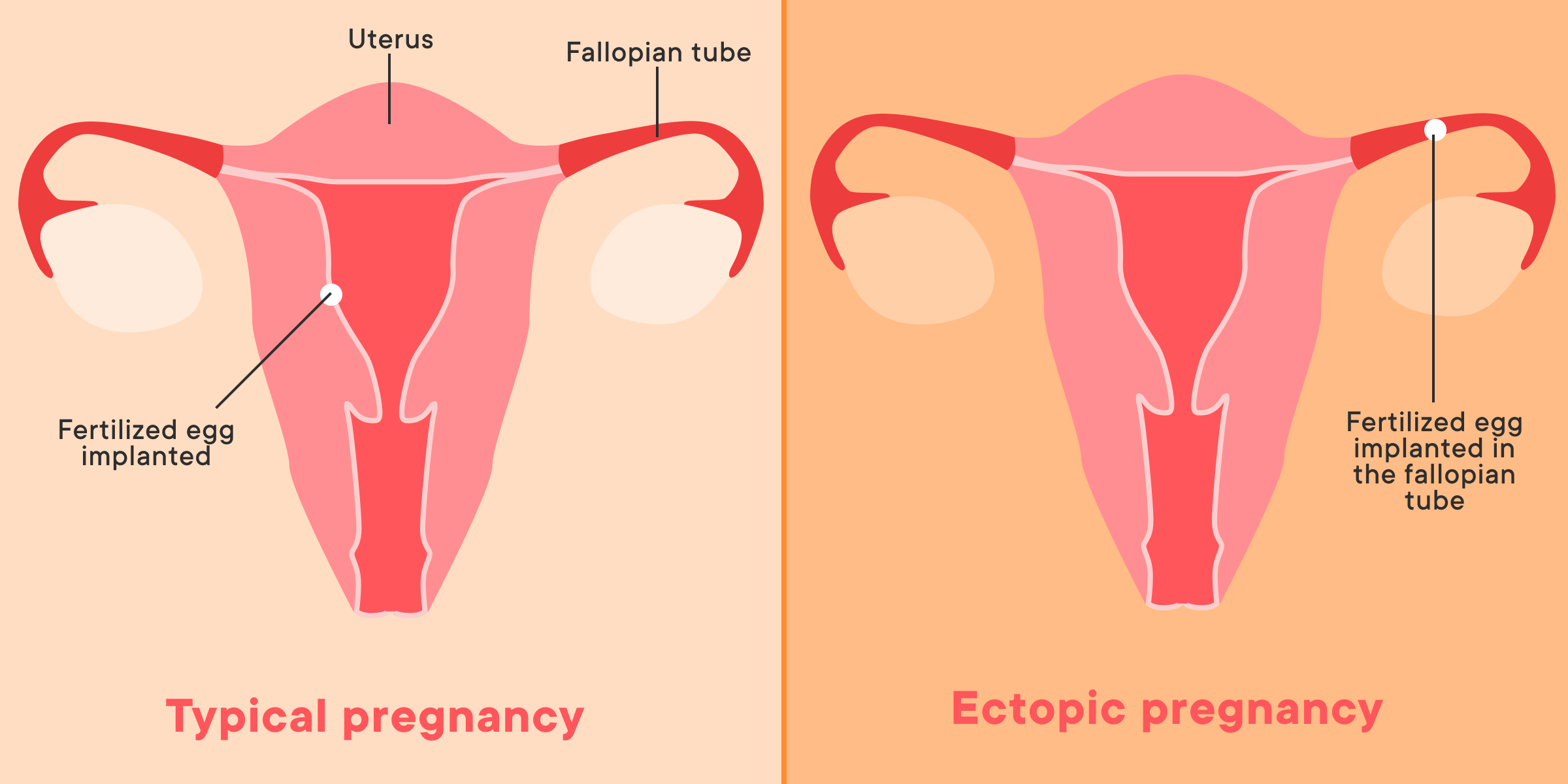 اعراض الحمل خارج الرحم 