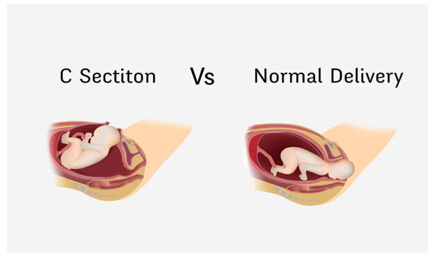 اختار الولادة الطبيعية أم القيصرية