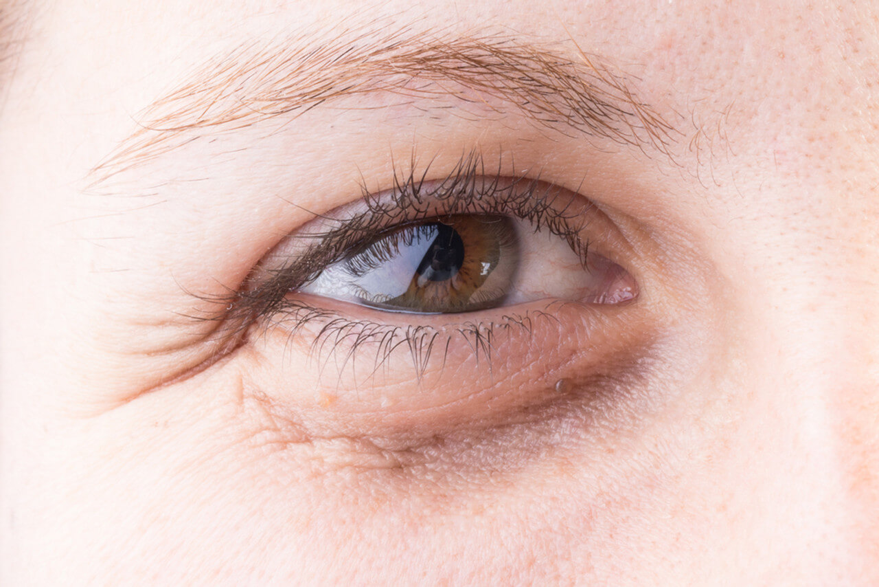ما هي الأسباب التي تسبب الهالات السوداء تحت العينين؟