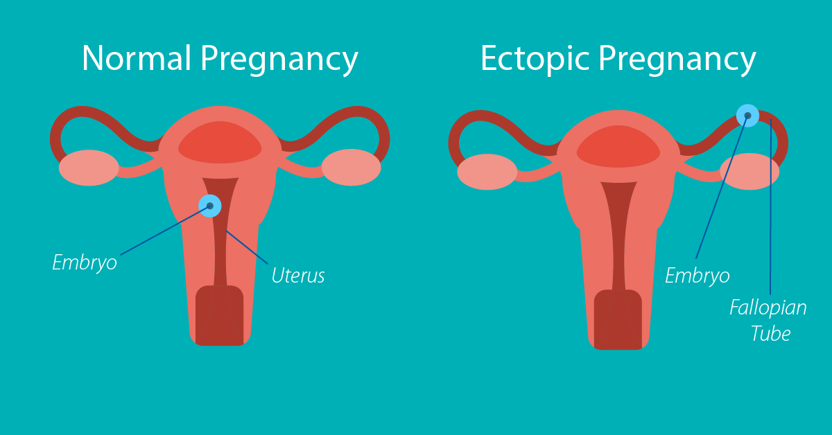 الفرق بين بين الحمل خارج الرحم والحمل الطبيعي