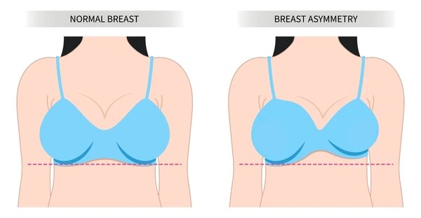 علاج اختلاف حجم الثدي